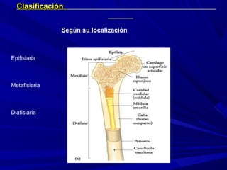 ClasificaciónClasificación
Según su localización
Epifisiaria
Metafisiaria
Diafisiaria
 