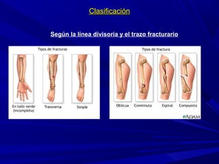 ClasificaciónClasificación
Según la línea divisoria y el trazo fracturario
 