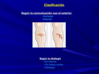 Según la comunicación con el exterior
-Cerradas
-Abiertas
Clasificación
Según la etiología
-Por trauma
- Por fatiga o estrés
- Patológica
 
