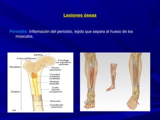 Lesiones óseasLesiones óseas
Periostitis: Inflamación del periostio, tejido que separa al hueso de los
músculos.
 