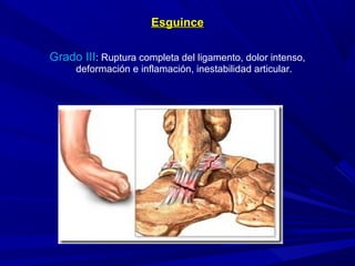 EsguinceEsguince
Grado III: Ruptura completa del ligamento, dolor intenso,
deformación e inflamación, inestabilidad articular.
 