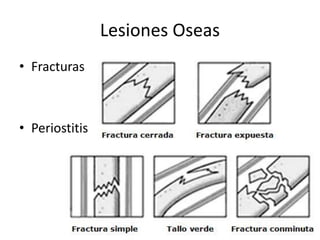 Lesiones Oseas 
• Fracturas 
• Periostitis 
 