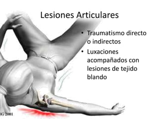 Lesiones Articulares 
• Traumatismo directo 
o indirectos 
• Luxaciones 
acompañados con 
lesiones de tejido 
blando 
 