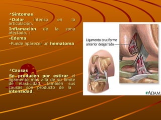 Síntomas Dolor  intenso en la articulación. Inflamación  de la zona afectada. :  -Edema -Puede aparecer un  hematoma Causas Se producen por estirar  el ligamento más allá de su límite de elasticidad. también sus causas son producto de la  intensidad . 