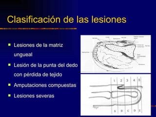 Clasificación de las lesiones

   Lesiones de la matriz
    ungueal
   Lesión de la punta del dedo
    con pérdida de tejido
   Amputaciones compuestas
   Lesiones severas
 