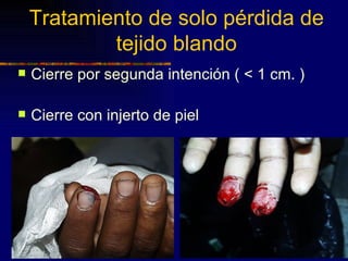 Tratamiento de solo pérdida de
            tejido blando
   Cierre por segunda intención ( < 1 cm. )

   Cierre con injerto de piel
 