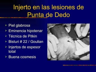 Injerto en las lesiones de
            Punta de Dedo
   Piel glabrosa
   Eminencia hipotenar
   Técnica de Pitkin
   Bisturi # 22 / Goulian
   Injertos de espesor
    total
   Buena cosmesis
 