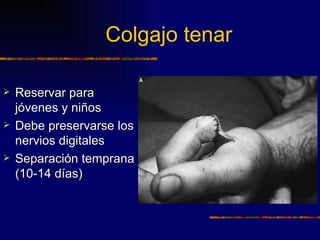 Colgajo tenar

   Reservar para
    jóvenes y niños
   Debe preservarse los
    nervios digitales
   Separación temprana
    (10-14 días)
 