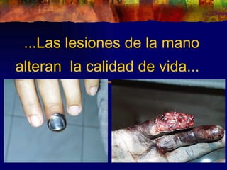 ...Las lesiones de la mano
alteran la calidad de vida...
 