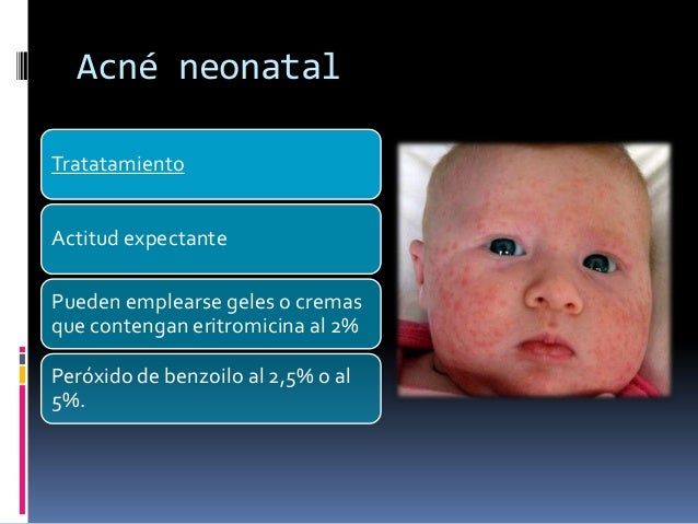 ¿Por qué sale el acné en el recién nacido y cómo curarlo? ¿Por qué sale el acné en el recién nacido y cómo curarlo?