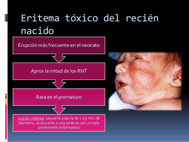 Eritema Toxico Del Recien Nacido Gpc es.slideshare.net