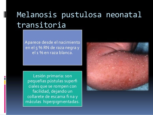 Lesiones dermatológicas del recién nacido sano