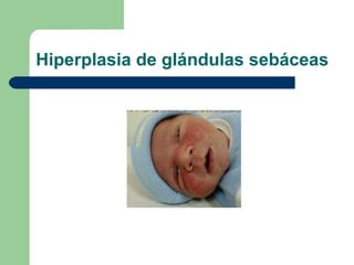 Hiperplasia de glándulas sebáceas
 