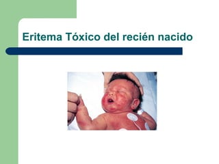 Eritema Tóxico del recién nacido
 