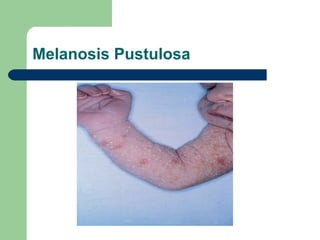 Melanosis Pustulosa
 