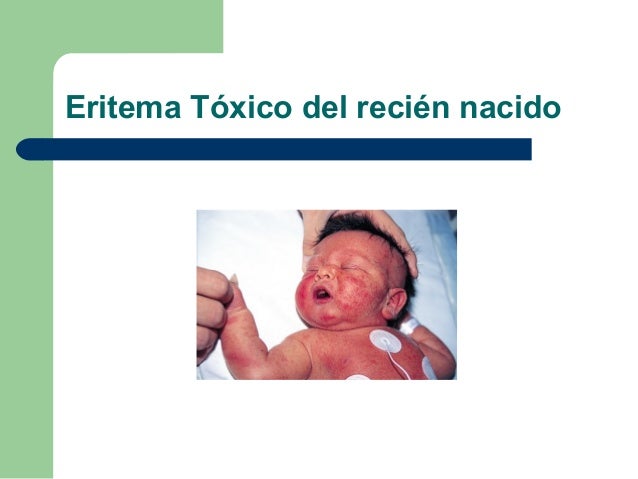 Eritema toxico recien nacido pdf creator