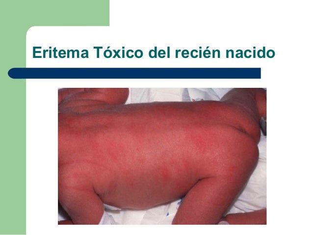 Si es útil el mar a la psoriasis