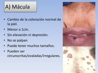 A) Mácula
• Cambio de la coloración normal de
la piel.
• Menor a 1cm.
• Sin elevación ni depresión.
• No se palpan
• Puede tener muchos tamaños.
• Pueden ser
circunscritas/ovaladas/irregulares.
 
