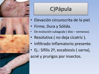 C)Pápula
• Elevación circunscrita de la piel.
• Firme, Dura y Sólida.
• De evolución subaguda ( días – semanas).
• Resolutiva ( no deja cicatriz ).
• Infiltrado Inflamatorio presente.
• Ej.: Sífilis 2ª, escabiosis ( sarna),
acné y prurigos por insectos.
 