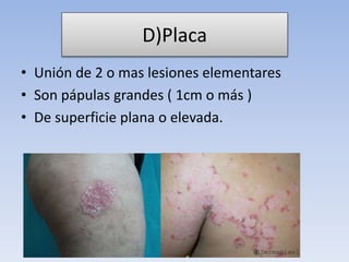 D)Placa
• Unión de 2 o mas lesiones elementares
• Son pápulas grandes ( 1cm o más )
• De superficie plana o elevada.
 
