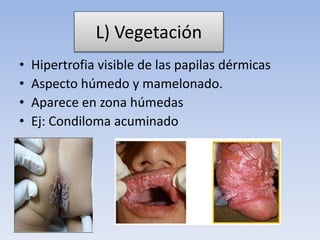 L) Vegetación
• Hipertrofia visible de las papilas dérmicas
• Aspecto húmedo y mamelonado.
• Aparece en zona húmedas
• Ej: Condiloma acuminado
 
