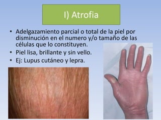 I) Atrofia
• Adelgazamiento parcial o total de la piel por
disminución en el numero y/o tamaño de las
células que lo constituyen.
• Piel lisa, brillante y sin vello.
• Ej: Lupus cutáneo y lepra.
 