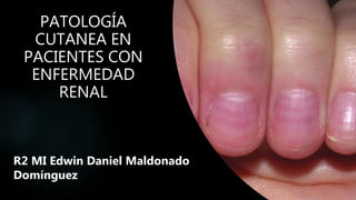 PATOLOGÍA
CUTANEA EN
PACIENTES CON
ENFERMEDAD
RENAL
R2 MI Edwin Daniel Maldonado
Domínguez
 