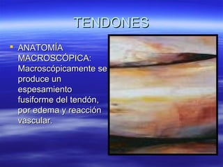 TTEENNDDOONNEESS 
 AANNAATTOOMMÍÍAA 
MMAACCRROOSSCCÓÓPPIICCAA:: 
MMaaccrroossccóóppiiccaammeennttee ssee 
pprroodduuccee uunn 
eessppeessaammiieennttoo 
ffuussiiffoorrmmee ddeell tteennddóónn,, 
ppoorr eeddeemmaa yy rreeaacccciióónn 
vvaassccuullaarr.. 
 