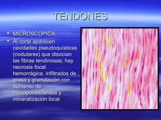 TTEENNDDOONNEESS 
 MMIICCRROOSSCCOOPPIICCAA:: 
 AAll ccoorrttee aappaarreecceenn 
ccaavviiddaaddeess ppsseeuuddooqquuííssttiiccaass 
((nnoodduullaarreess)) qquuee ddiissoocciiaann 
llaass ffiibbrraass tteennddiinnoossaass;; hhaayy 
nneeccrroossiiss ffooccaall 
hheemmoorrrráággiiccaa,, iinnffiillttrraaddooss ddee 
ggrraassaa yy ggrraannuullaacciióónn ccoonn 
aauummeennttoo ddee 
mmuuccooppoolliissaaccáárriiddooss yy 
mmiinneerraalliizzaacciióónn llooccaall 
 