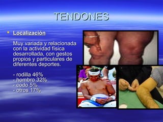 TTEENNDDOONNEESS 
 LLooccaalliizzaacciióónn 
MMuuyy vvaarriiaaddaa yy rreellaacciioonnaaddaa 
ccoonn llaa aaccttiivviiddaadd ffííssiiccaa 
ddeessaarrrroollllaaddaa,, ccoonn ggeessttooss 
pprrooppiiooss yy ppaarrttiiccuullaarreess ddee 
ddiiffeerreenntteess ddeeppoorrtteess.. 
-- rrooddiillllaa 4466%% 
-- hhoommbbrroo 3322%% 
-- ccooddoo 55%% 
-- oottrrooss 1177%% 
 