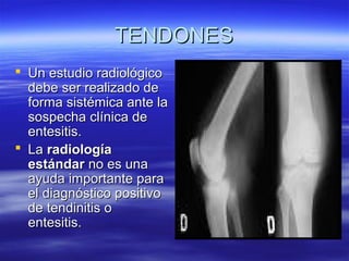 TTEENNDDOONNEESS 
 UUnn eessttuuddiioo rraaddiioollóóggiiccoo 
ddeebbee sseerr rreeaalliizzaaddoo ddee 
ffoorrmmaa ssiissttéémmiiccaa aannttee llaa 
ssoossppeecchhaa ccllíínniiccaa ddee 
eenntteessiittiiss.. 
 LLaa rraaddiioollooggííaa 
eessttáánnddaarr nnoo eess uunnaa 
aayyuuddaa iimmppoorrttaannttee ppaarraa 
eell ddiiaaggnnóóssttiiccoo ppoossiittiivvoo 
ddee tteennddiinniittiiss oo 
eenntteessiittiiss.. 
 