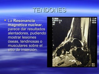 TTEENNDDOONNEESS 
 LLaa RReessoonnaanncciiaa 
mmaaggnnééttiiccaa nnuucclleeaarr,, 
ppaarreeccee ddaarr rreessuullttaaddooss 
aalleennttaaddoorreess,, ppuuddiieennddoo 
mmoossttrraarr lleessiioonneess 
óósseeaass,, tteennddiinnoossaass oo 
mmuussccuullaarreess ssoobbrree eell 
ssiittiioo ddee iinnsseerrcciióónn.. 
 