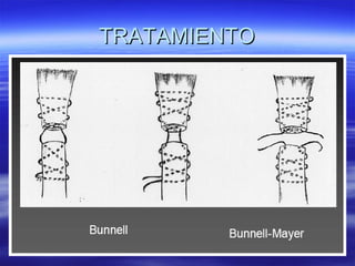 TTRRAATTAAMMIIEENNTTOO 
 