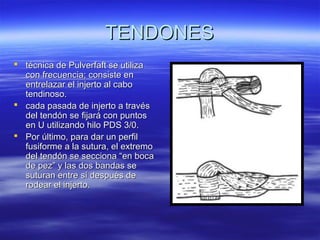 TTEENNDDOONNEESS 
 ttééccnniiccaa ddee PPuullvveerrffaafftt ssee uuttiilliizzaa 
ccoonn ffrreeccuueenncciiaa;; ccoonnssiissttee eenn 
eennttrreellaazzaarr eell iinnjjeerrttoo aall ccaabboo 
tteennddiinnoossoo.. 
 ccaaddaa ppaassaaddaa ddee iinnjjeerrttoo aa ttrraavvééss 
ddeell tteennddóónn ssee ffiijjaarráá ccoonn ppuunnttooss 
eenn UU uuttiilliizzaannddoo hhiilloo PPDDSS 33//00.. 
 PPoorr úúllttiimmoo,, ppaarraa ddaarr uunn ppeerrffiill 
ffuussiiffoorrmmee aa llaa ssuuttuurraa,, eell eexxttrreemmoo 
ddeell tteennddóónn ssee sseecccciioonnaa ““eenn bbooccaa 
ddee ppeezz”” yy llaass ddooss bbaannddaass ssee 
ssuuttuurraann eennttrree ssíí ddeessppuuééss ddee 
rrooddeeaarr eell iinnjjeerrttoo.. 
 