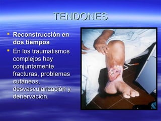 TTEENNDDOONNEESS 
 RReeccoonnssttrruucccciióónn eenn 
ddooss ttiieemmppooss 
 EEnn llooss ttrraauummaattiissmmooss 
ccoommpplleejjooss hhaayy 
ccoonnjjuunnttaammeennttee 
ffrraaccttuurraass,, pprroobblleemmaass 
ccuuttáánneeooss,, 
ddeessvvaassccuullaarriizzaacciióónn yy 
ddeenneerrvvaacciióónn.. 
 