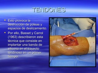 TTEENNDDOONNEESS 
 EEssttoo pprroovvooccaa llaa 
ddeessttrruucccciióónn ddee ppoolleeaass yy 
eessppaacciiooss ddee ddeesslliizzaammiieennttoo.. 
 PPoorr eelllloo,, BBaasssseett yy CCaarrrrooll 
((1196633)) ddeessccrriibbiieerroonn eessttaa 
ttééccnniiccaa qquuee ccoonnssiissttee eenn 
iimmppllaannttaarr uunnaa bbaannddaa ddee 
ssiilliiccoonnaa eenn eell ttrraayyeeccttoo 
tteennddiinnoossoo eenn uunn pprriimmeerr 
ttiieemmppoo.. 
 