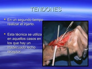 TTEENNDDOONNEESS 
 EEnn uunn sseegguunnddoo ttiieemmppoo 
rreeaalliizzaarr eell iinnjjeerrttoo.. 
 EEssttaa ttééccnniiccaa ssee uuttiilliizzaa 
eenn aaqquueellllooss ccaassooss eenn 
llooss qquuee hhaayy uunn 
iinnaaddeeccuuaaddoo lleecchhoo 
rreecceeppttoorr.. 
 