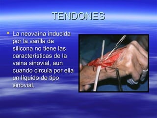 TTEENNDDOONNEESS 
 LLaa nneeoovvaaíínnaa iinndduucciiddaa 
ppoorr llaa vvaarriillllaa ddee 
ssiilliiccoonnaa nnoo ttiieennee llaass 
ccaarraacctteerrííssttiiccaass ddee llaa 
vvaaiinnaa ssiinnoovviiaall,, aauunn 
ccuuaannddoo cciirrccuullaa ppoorr eellllaa 
uunn llííqquuiiddoo ddee ttiippoo 
ssiinnoovviiaall.. 
 