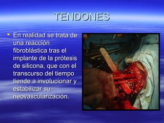 TTEENNDDOONNEESS 
 EEnn rreeaalliiddaadd ssee ttrraattaa ddee 
uunnaa rreeaacccciióónn 
ffiibbrroobblláássttiiccaa ttrraass eell 
iimmppllaannttee ddee llaa pprróótteessiiss 
ddee ssiilliiccoonnaa,, qquuee ccoonn eell 
ttrraannssccuurrssoo ddeell ttiieemmppoo 
ttiieennddee aa iinnvvoolluucciioonnaarr yy 
eessttaabbiilliizzaarr ssuu 
nneeoovvaassccuullaarriizzaacciióónn.. 
 