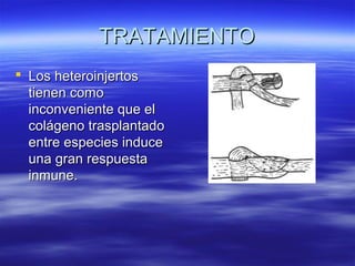 TTRRAATTAAMMIIEENNTTOO 
 LLooss hheetteerrooiinnjjeerrttooss 
ttiieenneenn ccoommoo 
iinnccoonnvveenniieennttee qquuee eell 
ccoolláággeennoo ttrraassppllaannttaaddoo 
eennttrree eessppeecciieess iinndduuccee 
uunnaa ggrraann rreessppuueessttaa 
iinnmmuunnee.. 
 