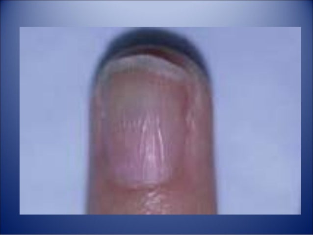 Cura el hongo en la oreja