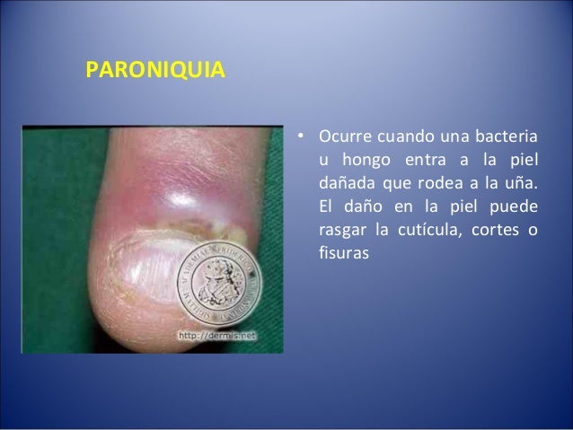 Ketokonazol del hongo de los pie