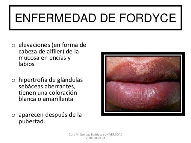 La crema para uvelich del miembro