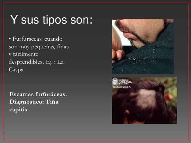 Los métodos del tratamiento contra la psoriasis