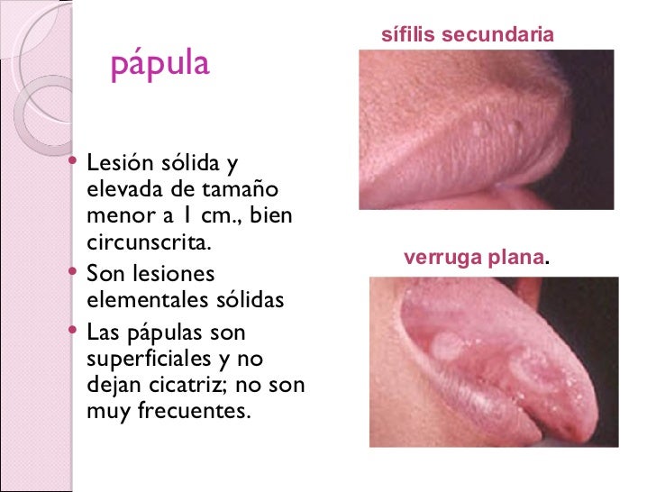 Como son las verrugas del vph fotos 52 Como son las verrugas del vph fotos 46