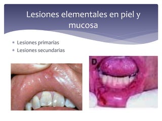  Lesiones primarias
 Lesiones secundarias
Lesiones elementales en piel y
mucosa
 