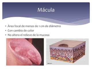  Área focal de menos de 1 cm de diámetro
 Con cambio de color
 No altera el relieve de la mucosa
Mácula
 