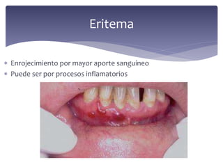  Enrojecimiento por mayor aporte sanguíneo
 Puede ser por procesos inflamatorios
Eritema
 