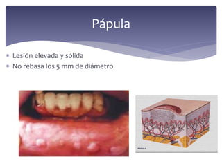  Lesión elevada y sólida
 No rebasa los 5 mm de diámetro
Pápula
 