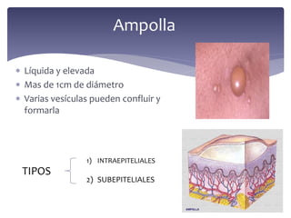  Líquida y elevada
 Mas de 1cm de diámetro
 Varias vesículas pueden confluir y
formarla
Ampolla
TIPOS
1) INTRAEPITELIALES
2) SUBEPITELIALES
 